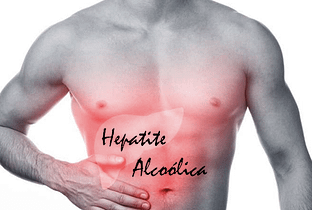 Hepatite alcóolica