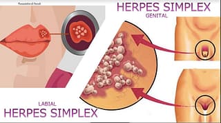 Herpes labial X herpes genital – Diferenças