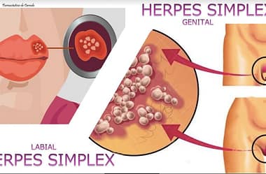 Herpes labial X herpes genital – Diferenças